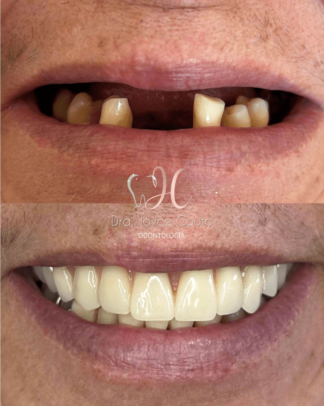 Antes e depois de prótese
