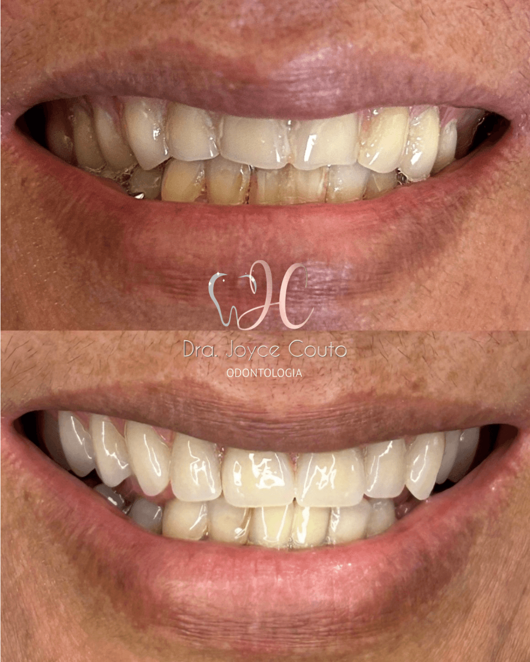 Antes e depois de prótese total