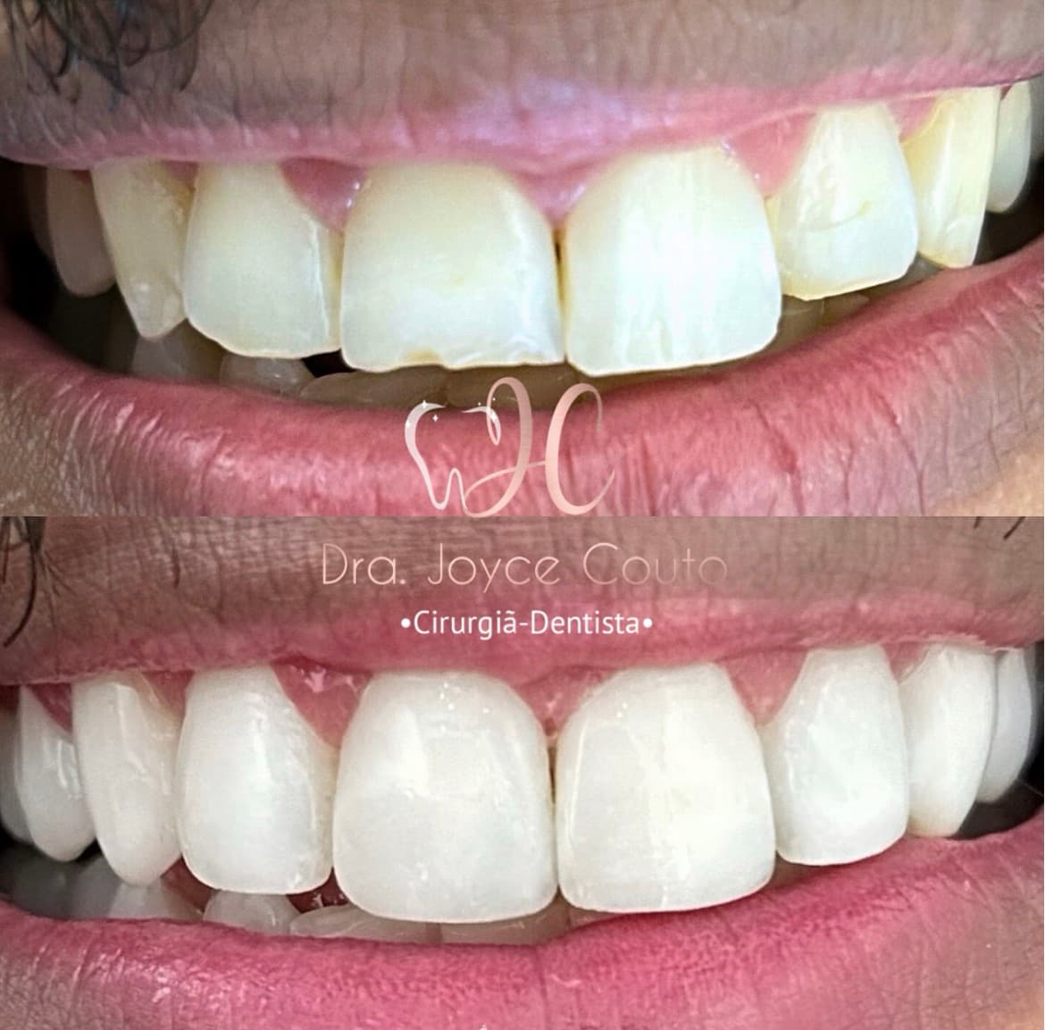 Antes e depois de facetas em resina
