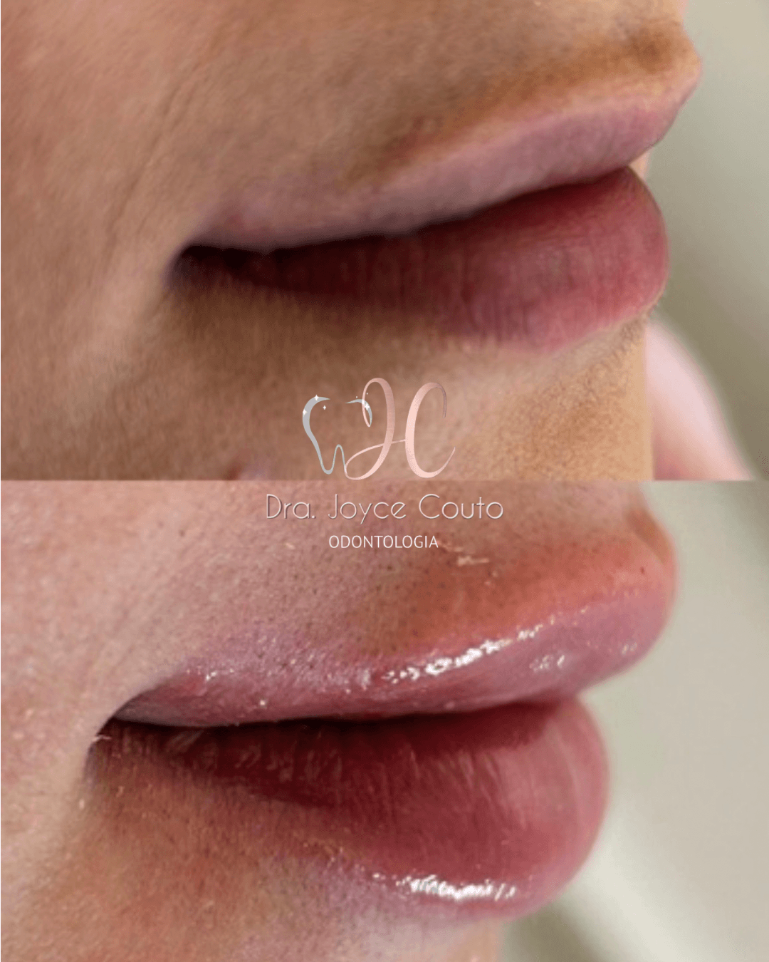 Antes e depois de preenchimento labial